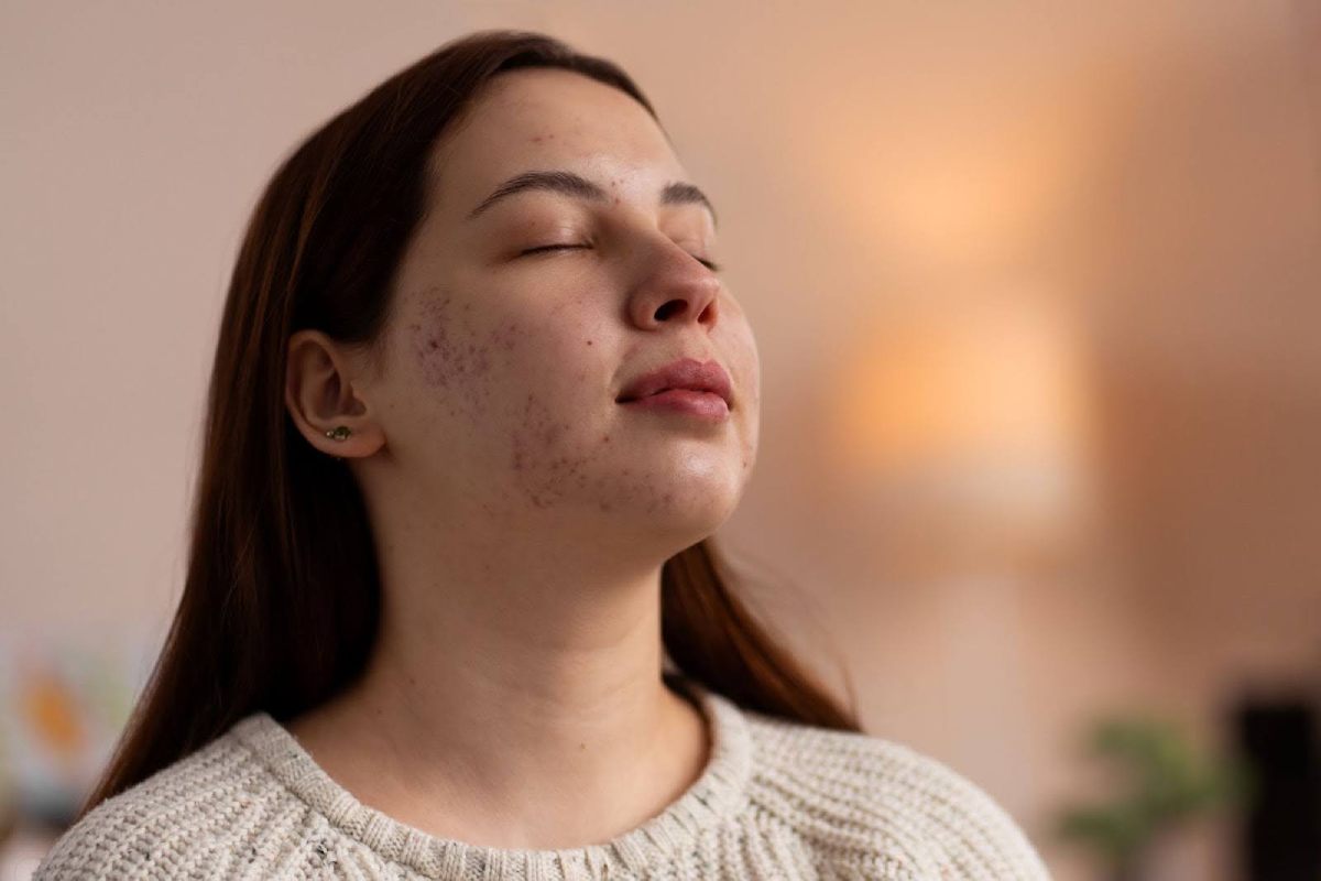Say Goodbye to Acne Scars with Advanced Laser Treatment in Pune