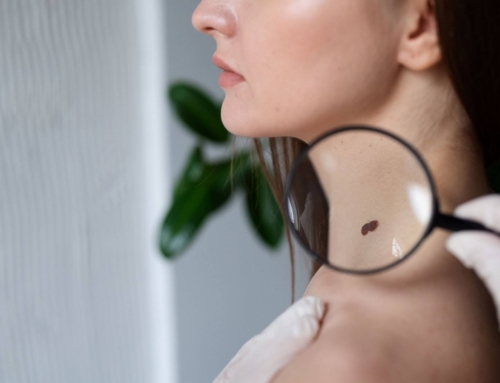 Quick and Easy Skin Tag Removal: Which Treatment Works Best?